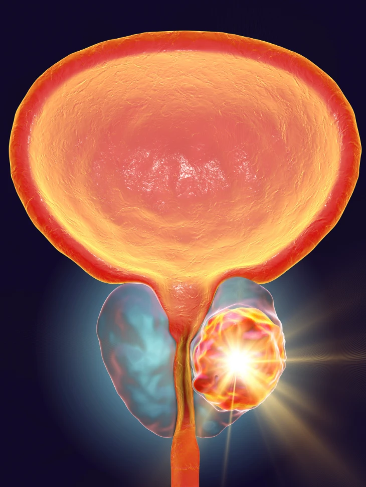 Cancer de la prostate Cancer de la prostate