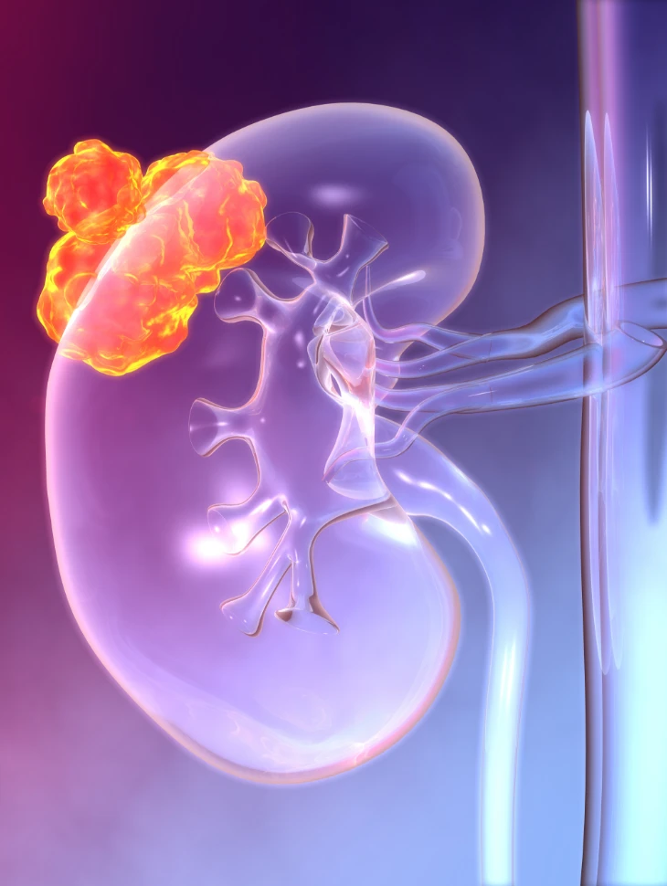 Cancer du rein Cancer du rein