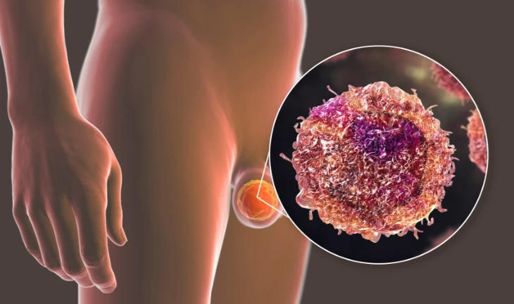 Cancer du testicule Cancer du testicule