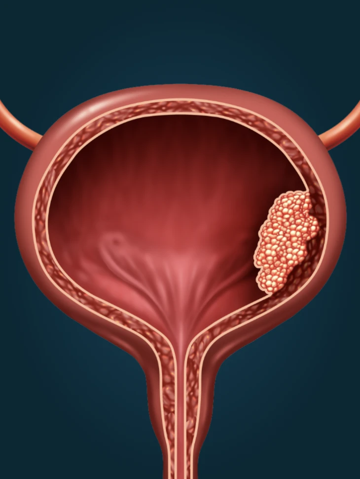 Cancer de la vessie Cancer de la vessie