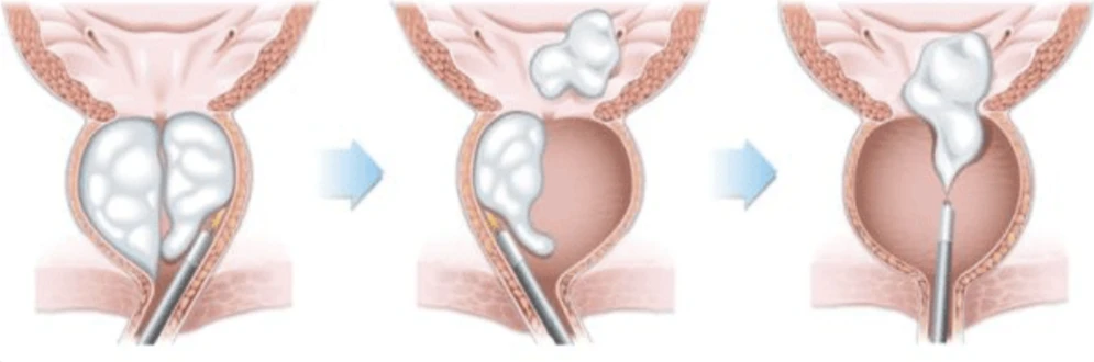 Énucléation de la prostate au laser GreenLight (GreenLEP) / Holmium (HoLEP) Énucléation de la prostate au laser GreenLight (GreenLEP) / Holmium (HoLEP)