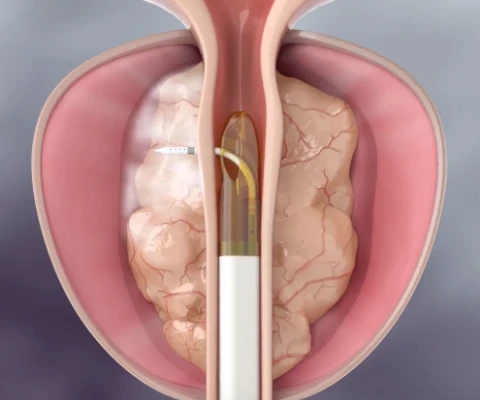 Thermothérapie pour traiter l'hypertrophie bénigne de la prostate Thermothérapie pour traiter l'hypertrophie bénigne de la prostate